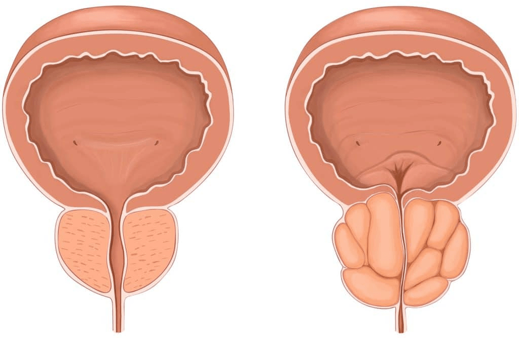 Was passiert mit der Prostata bei Prostatitis 