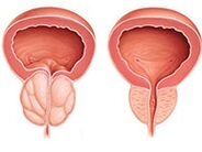 Prostatitis