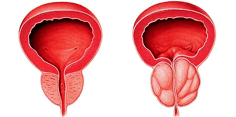 Normale und entzündete Prostata